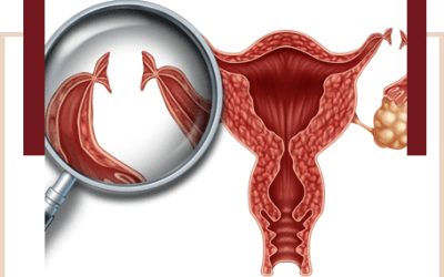 Cirurgia para Laqueadura Tubária