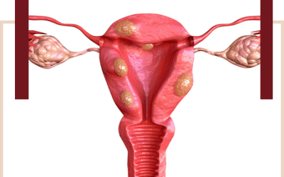 Miomas Uterinos: Quando operar?